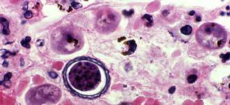 Acanthamoeba - Granulomatous Amebic Encephalitis (GAE); Keratitis |  Acanthamoeba | Parasites | CDC